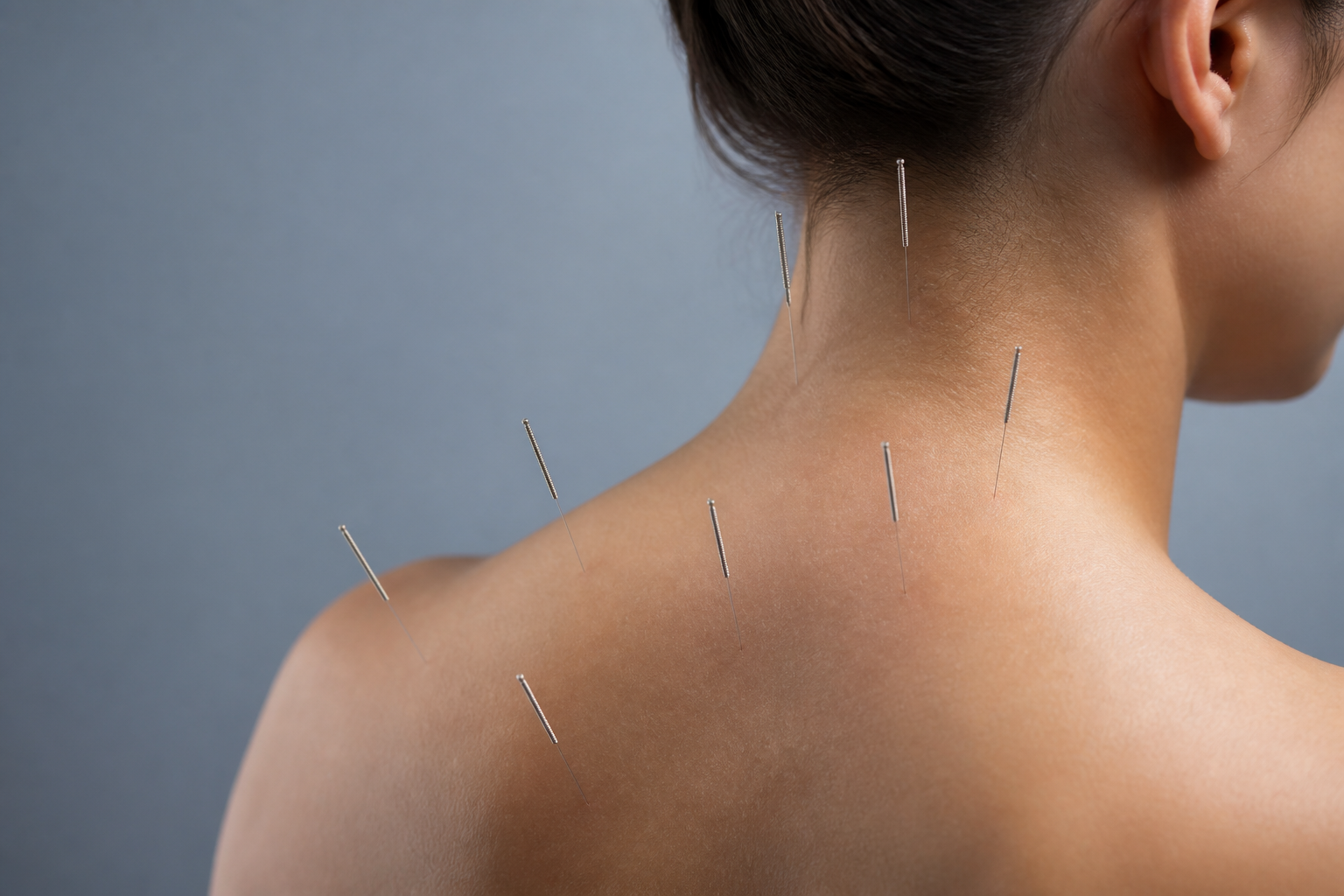 Aiguilles d'acupuncture insérées sur la nuque et le dos le long des méridiens